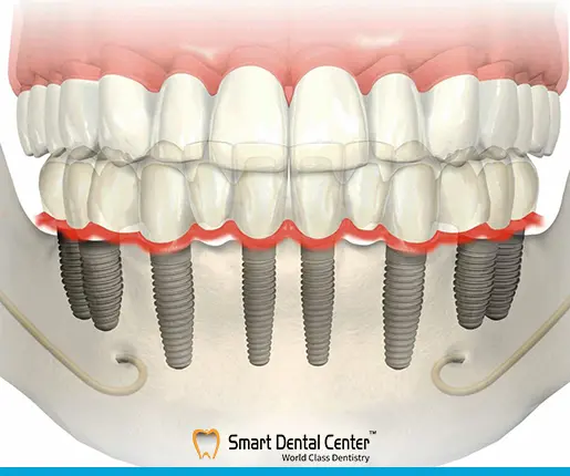 مدة زراعة الاسنان