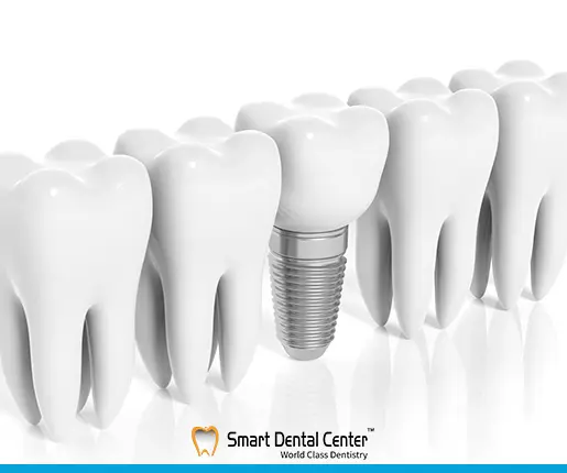 انواع زراعة الاسنان واسعارها