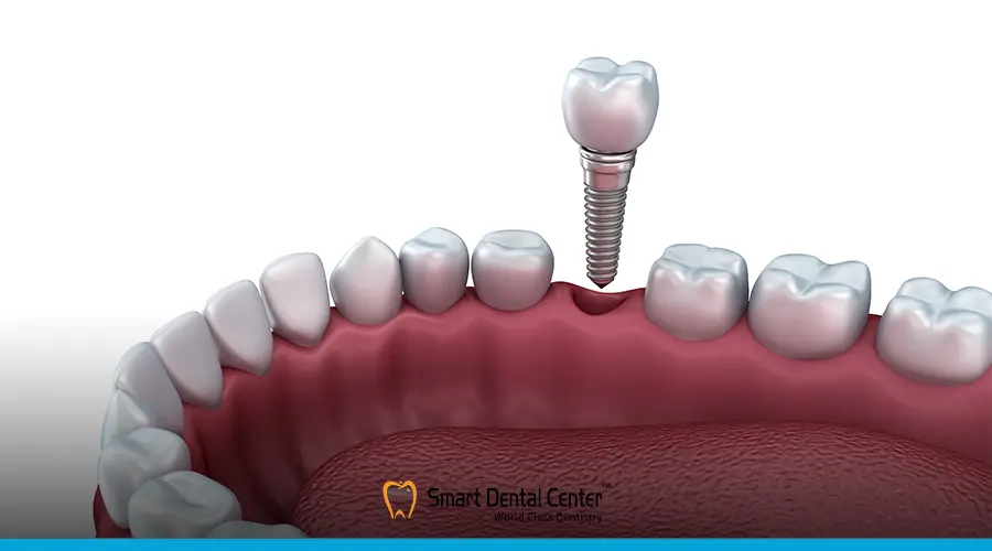 اسعار زرع الاسنان