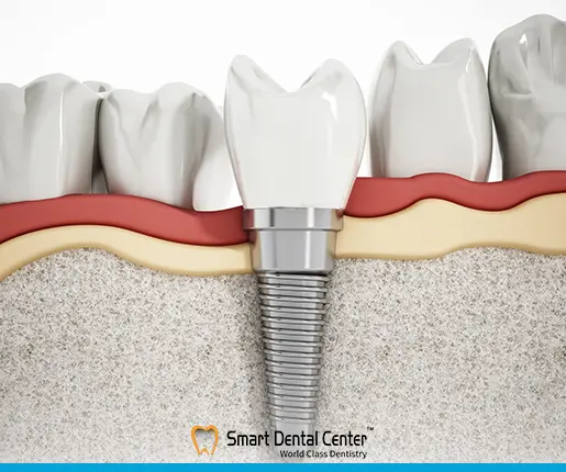 اسعار زراعة الاسنان فى مصر