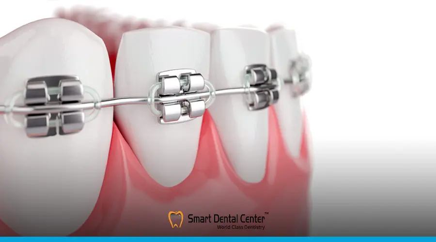 مدة تقويم الاسنان