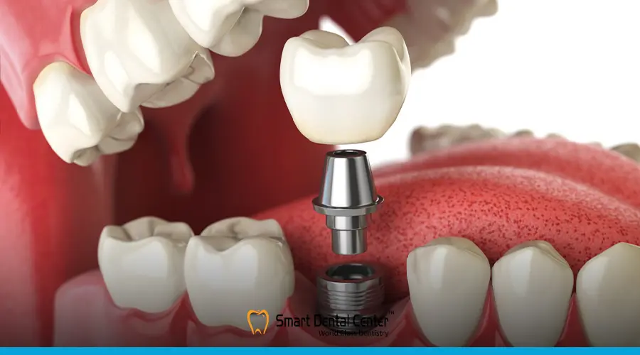 تركيبات الاسنان