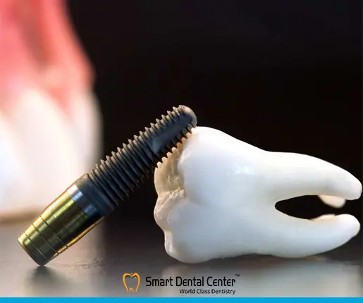 بدائل زراعة الاسنان