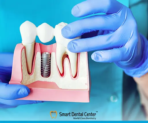 عيوب زراعة الاسنان