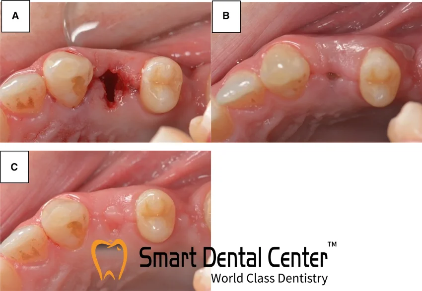 شكل اللثة بعد خلع الضرس العقل