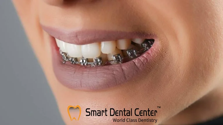 متى تبدا الاسنان تتحرك بعد التقويم