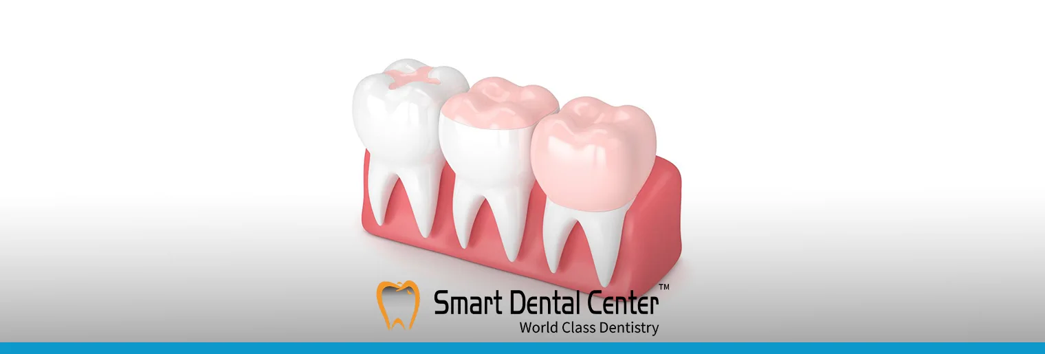 انواع حشو الاسنان