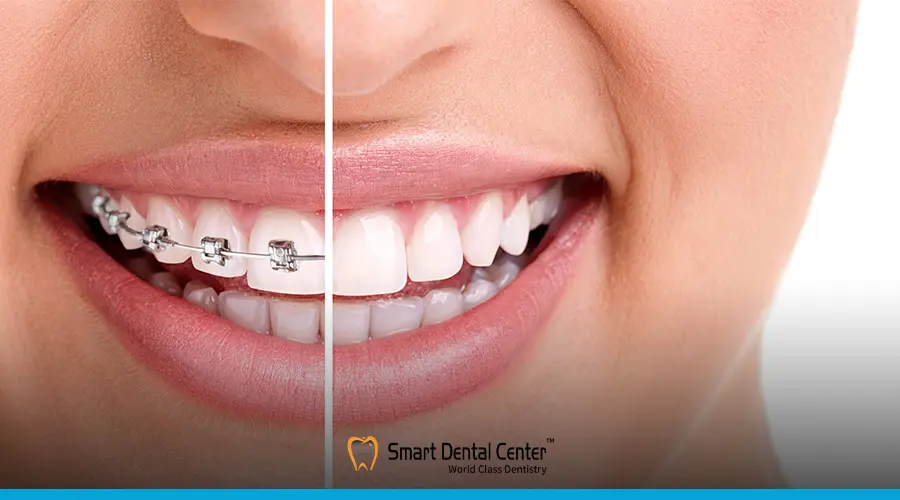 الفرق بين بروز الفك وبروز الاسنان