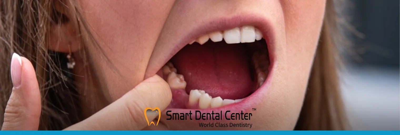 متى تلتئم اللثة بعد خلع الضرس