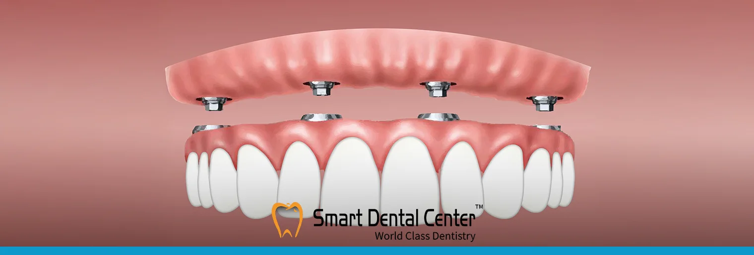مشاكل تركيبات الاسنان الثابتة